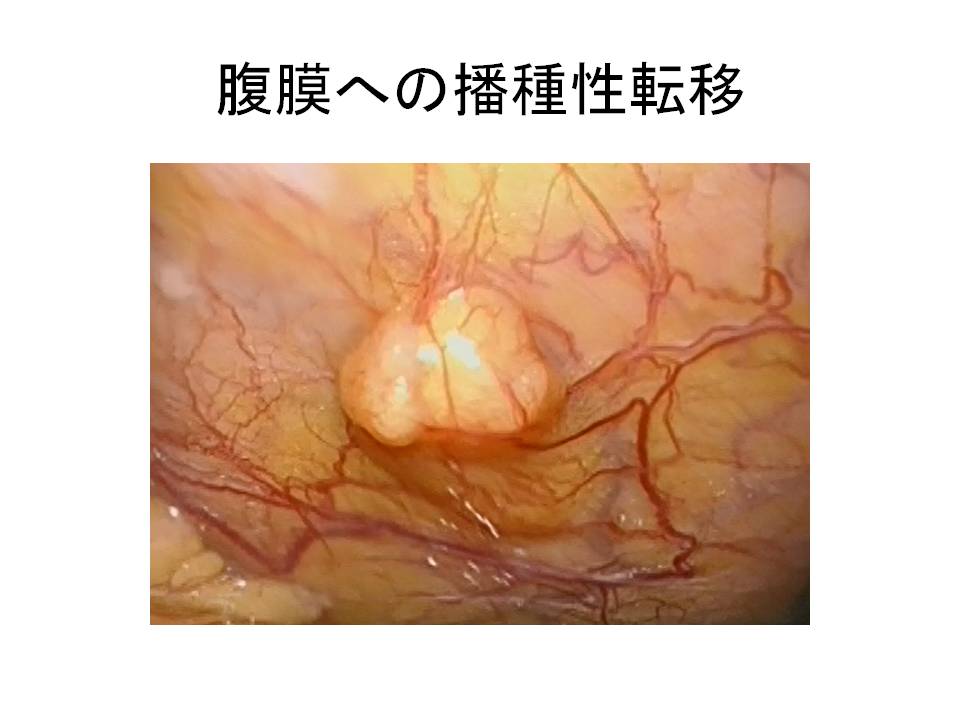 腹膜播種の内視鏡画像